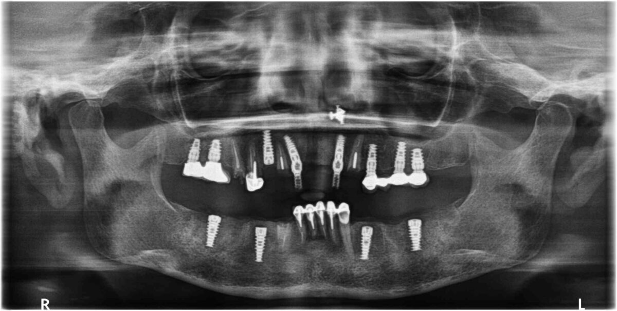 Dental Implants