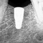 Dental Implant Nagpur