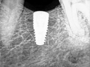 Dental Implant Nagpur